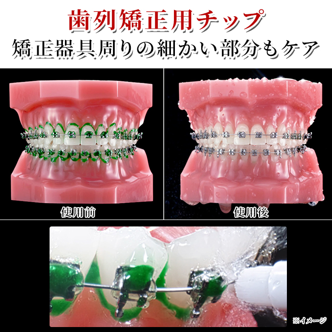 ウォーターピック専用の歯列矯正用チップ