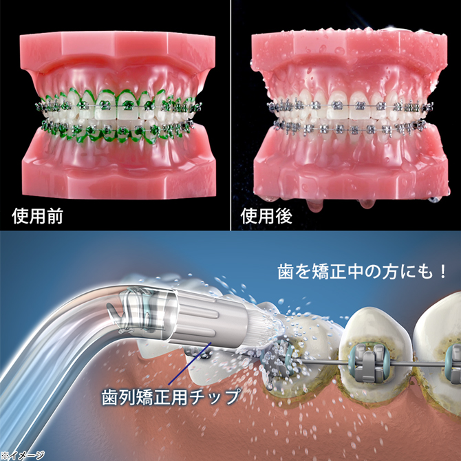 歯列矯正用チップ