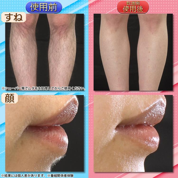 今 お得！】リファ エピ ゴー（ReFa EPI GO）／光美容器／ムダ毛ケア