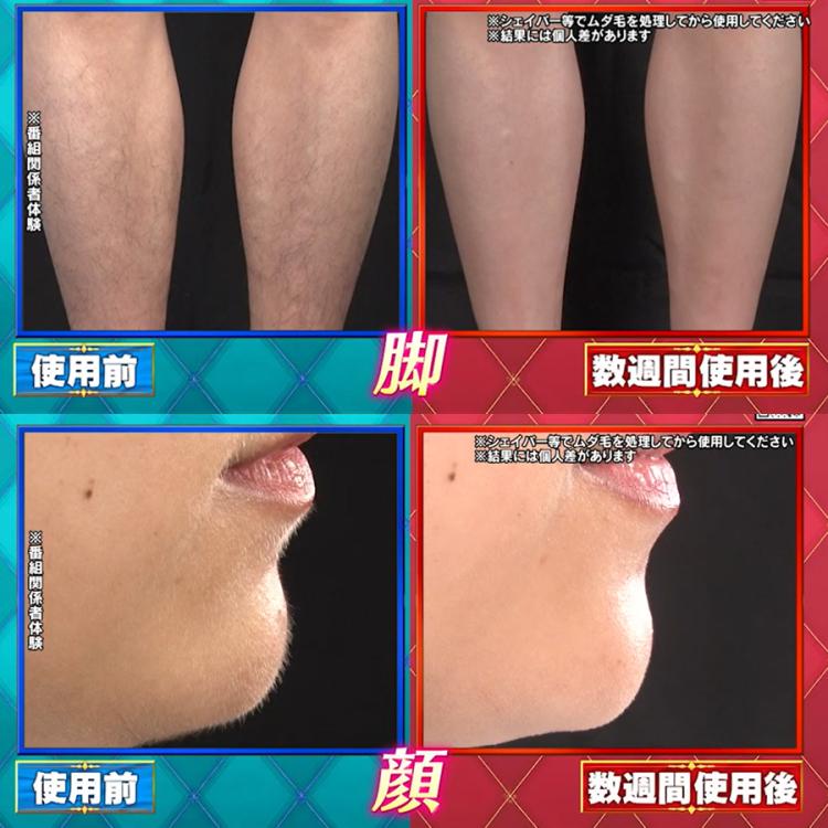 YAMANレイボーテ ヴィーナス ビューティープラス／フラッシュ式ムダ毛ケア レイボーテ ヴィーナス ビューティープラス／ヤーマン／フラッシュ式